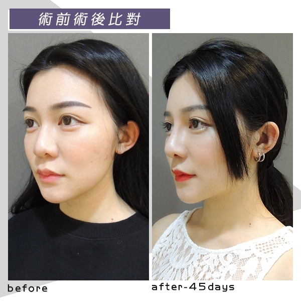 三段式隆鼻, 韓式隆鼻, 結構式隆鼻 三段式隆鼻, 韓式隆鼻, 結構式隆鼻